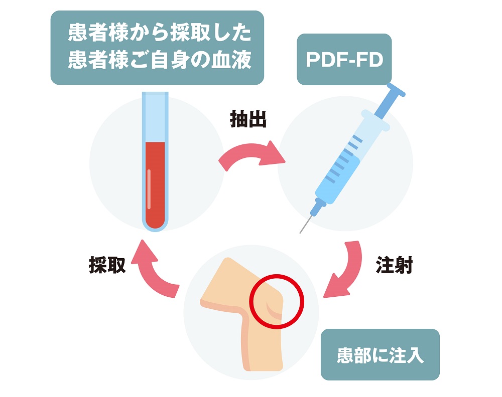 PDF-FD療法のしくみ