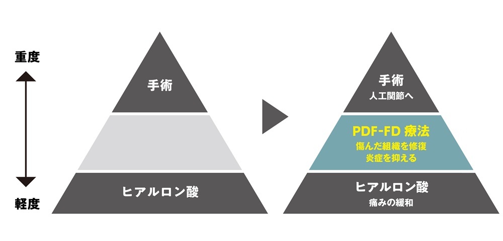 膝の痛みの新しい治療法 PDF-FD療法