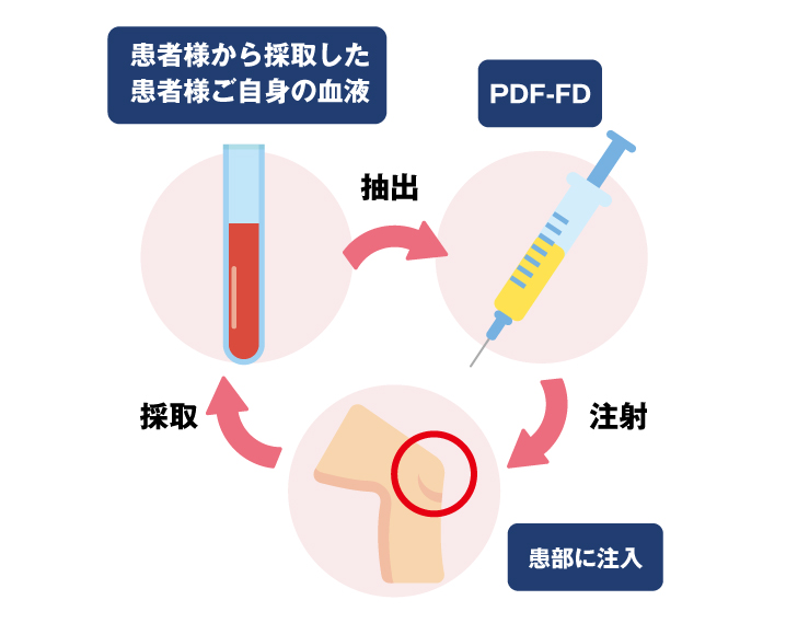 次世代オーダーメイド治療　PDF-FD治療